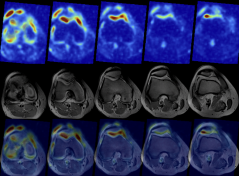Phsyiological sodium and structural hydrogen MRI overlaid.