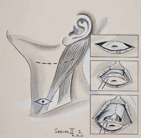 Excision of a second branchial cleft (Series II–1), c. 1960