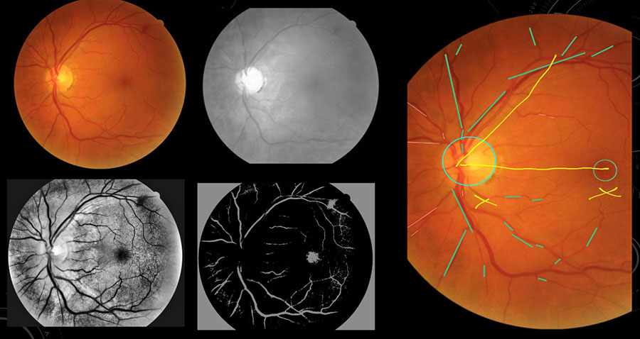 fundus image feautre extraction